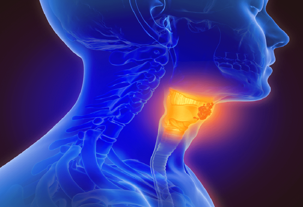 سرطان الحنجرة الذكاء الاصطناعي